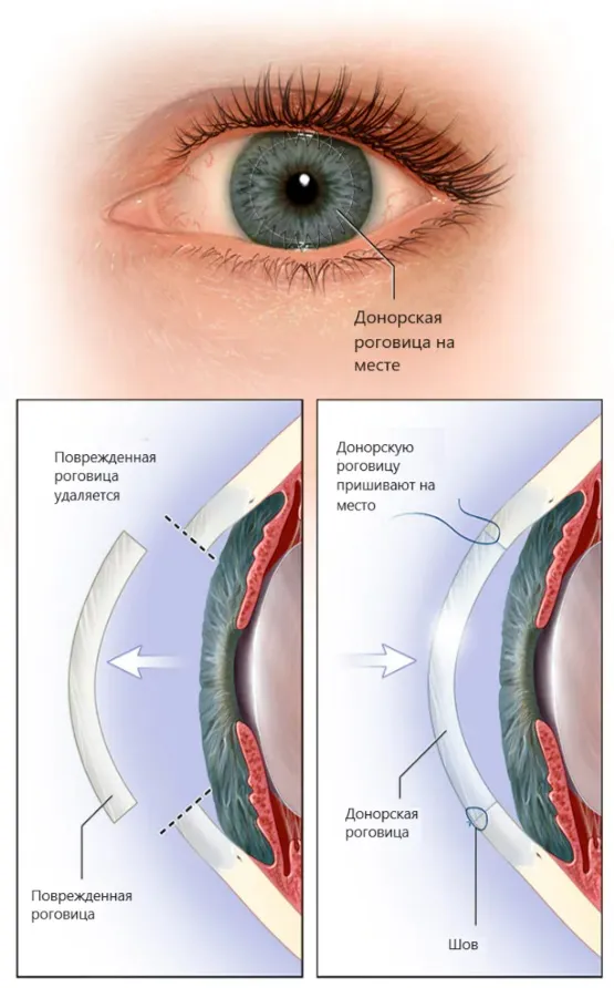 Трансплантация (кератопластика) при дистрофии роговицы