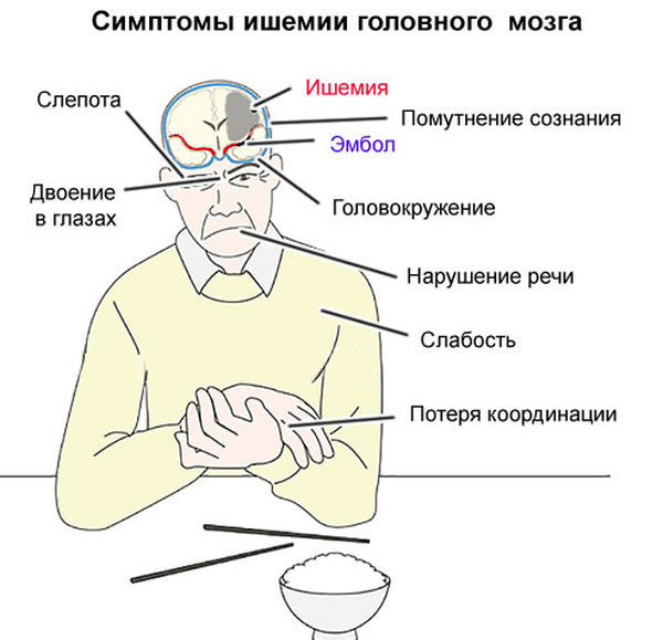 Ишемическая болезнь сердца (ИБС)