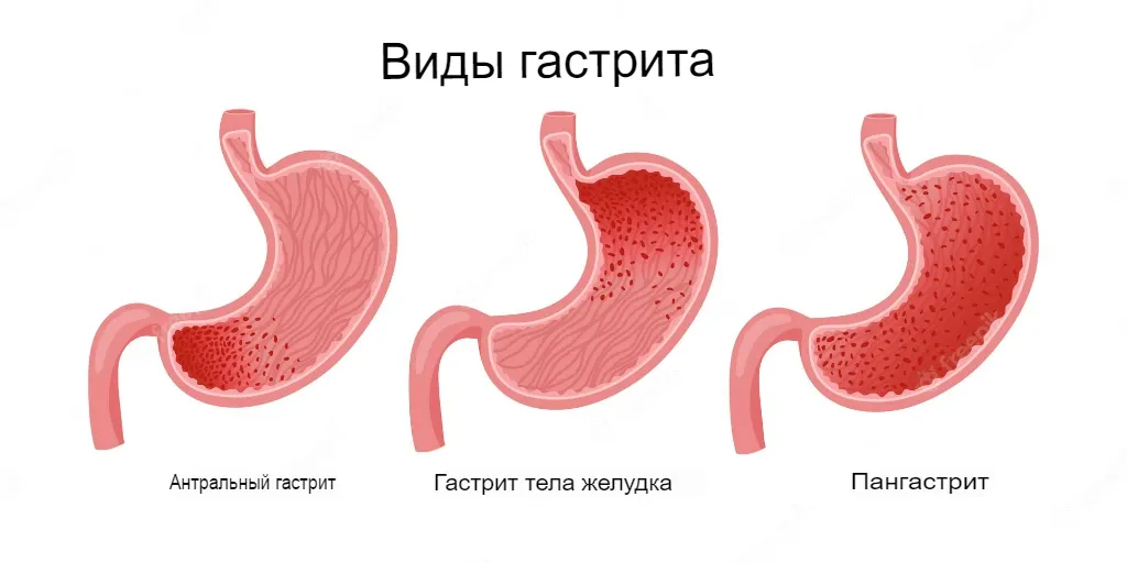 Гастрит — симптомы и лечение, признаки гастрита желудка. | Доктор КИТ