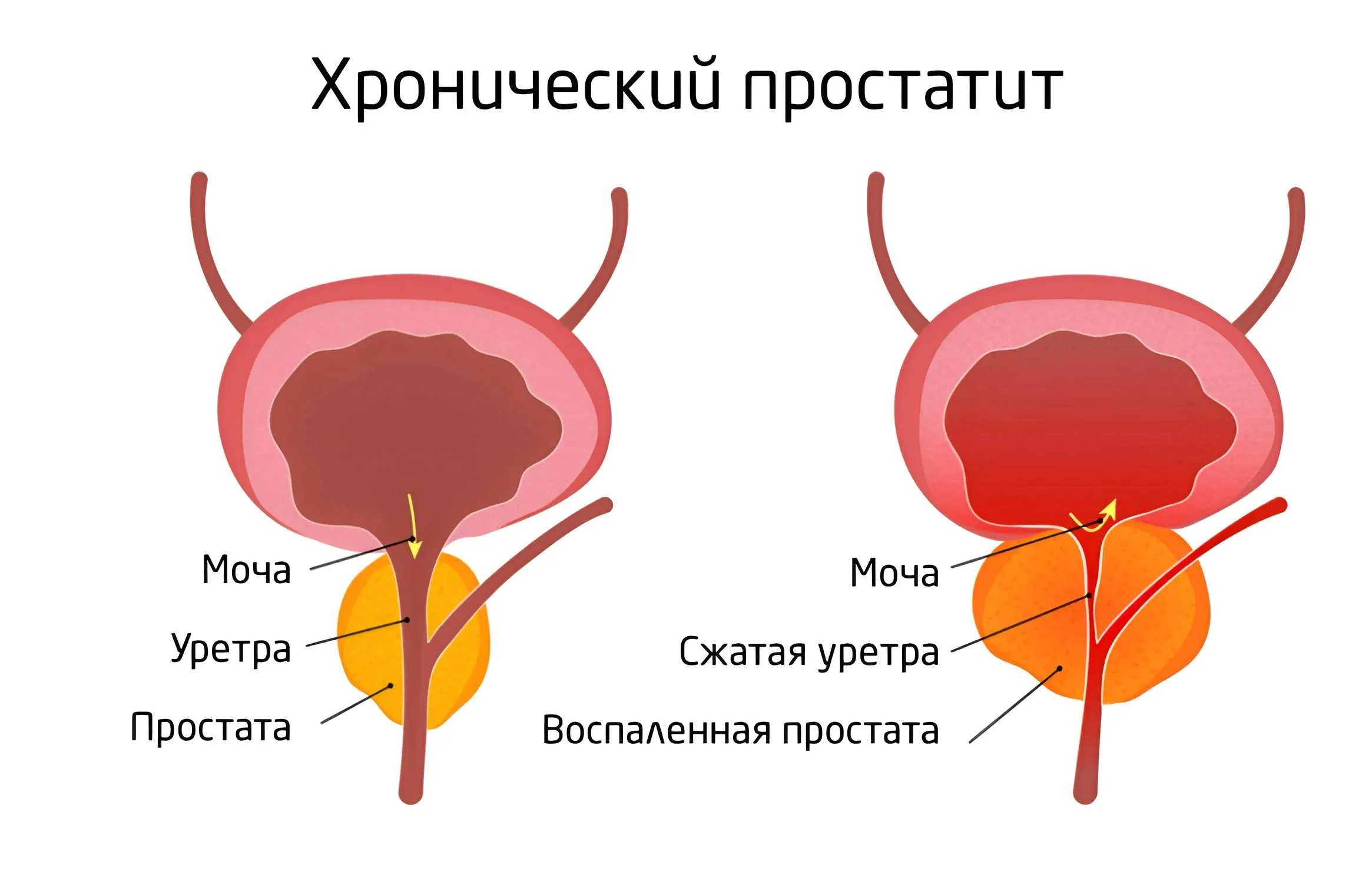 Застойный простатит, его диагностика, профилактика и влияние на мужское здоровье