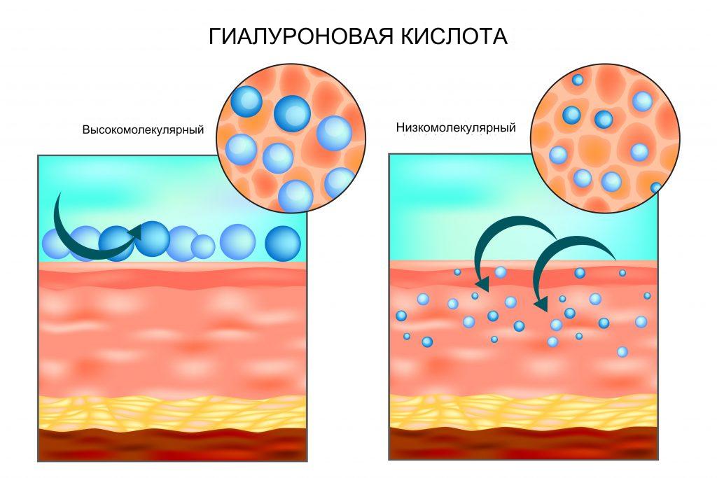 Какие бывают виды гиалуроновой кислоты