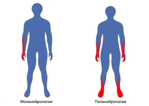 Первые признаки полинейропатии