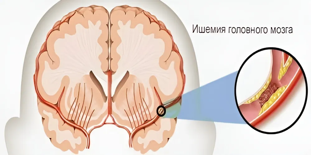 Лечение ишемической болезни сердца, цены в Москве в Evolutis Clinic