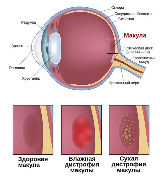 Отек макулы