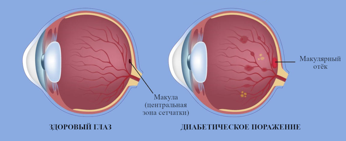 Отек макулы - фото 2