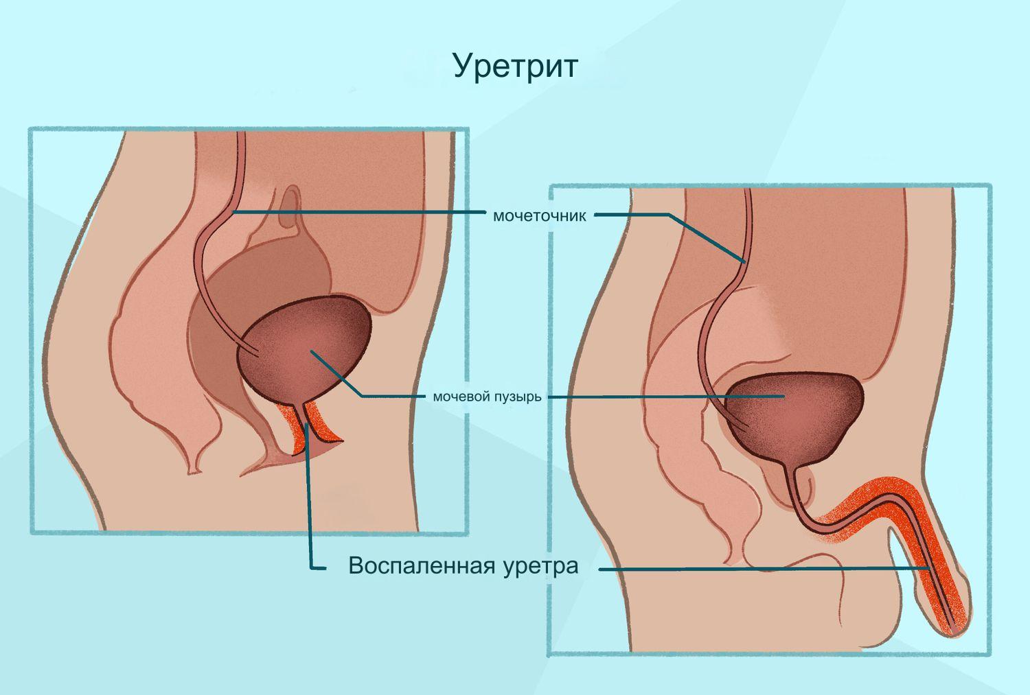 Уретрит, симптомы и признаки. Лечение уретрита у мужчин и у женщин.