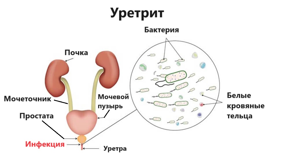 Хронический уретрит 2