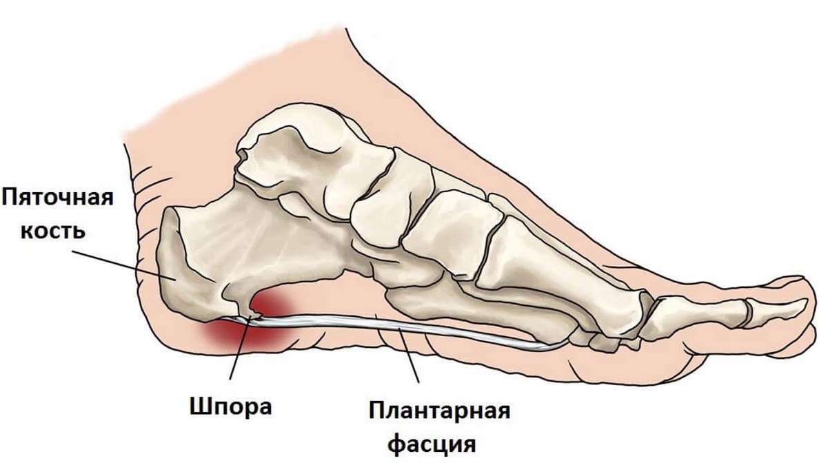 Пяточная шпора