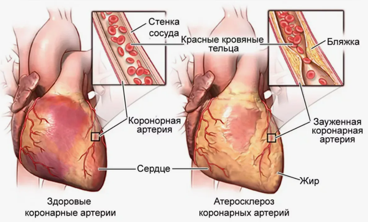 Стенокардия 2