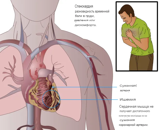 Стенокардия 1