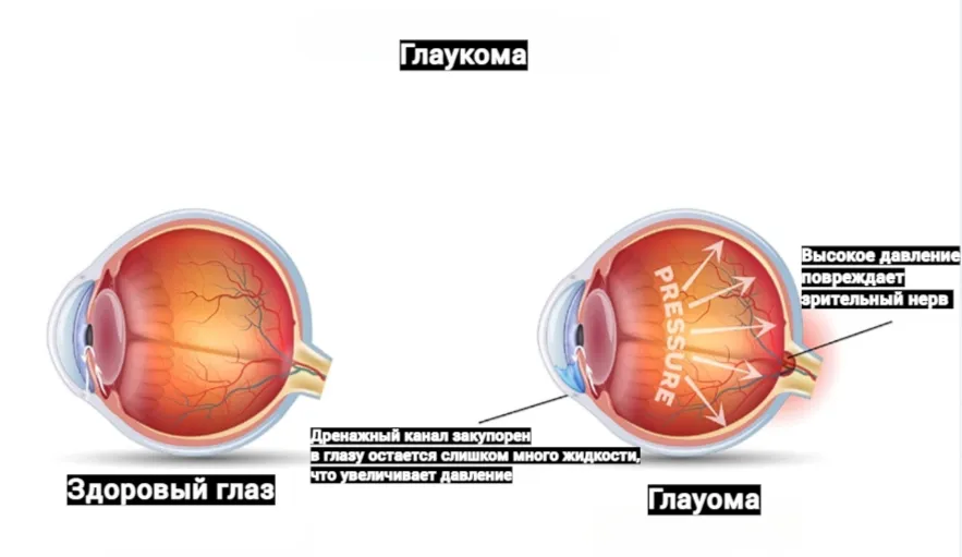 Что можно и чего нельзя делать при глаукоме