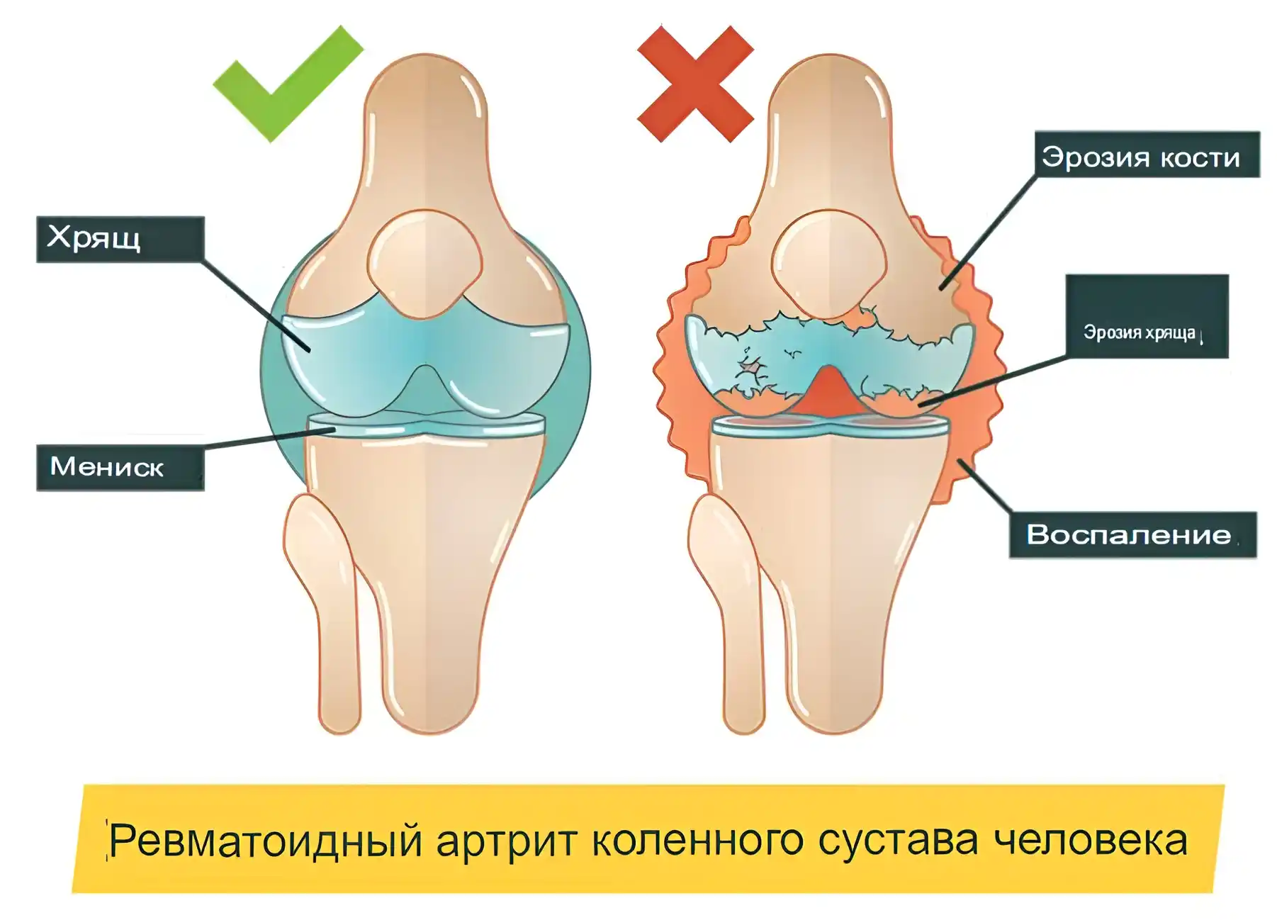 Ревматоидный артрит