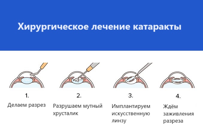 Катаракта лечится или нет. Катаракта лечится или нет