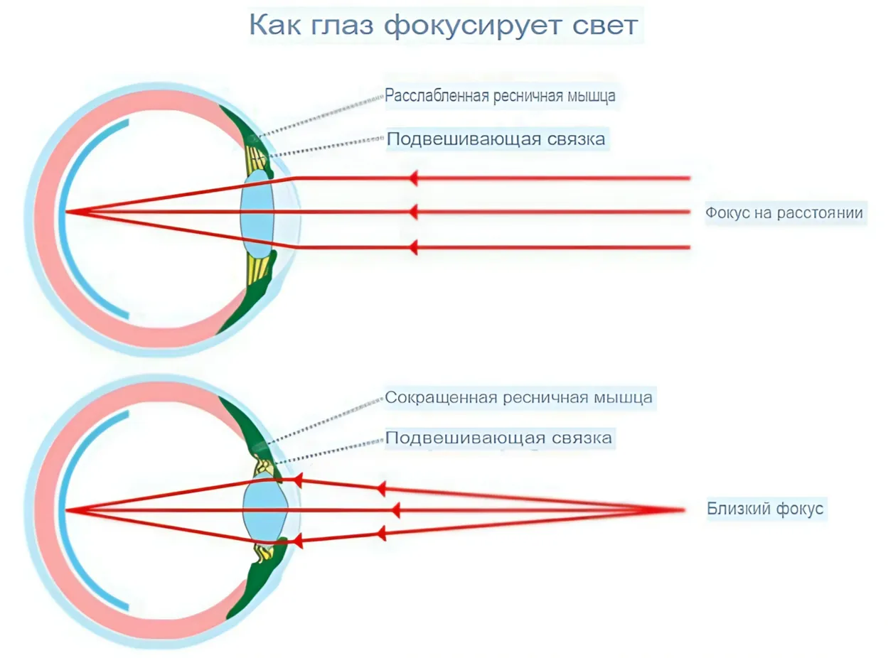 Миопия (Близорукость) 2