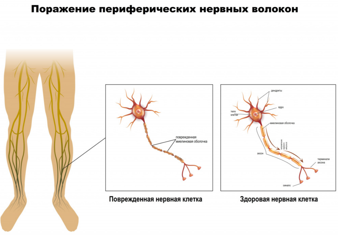 Лечение диабетической нейропатии в Житомире