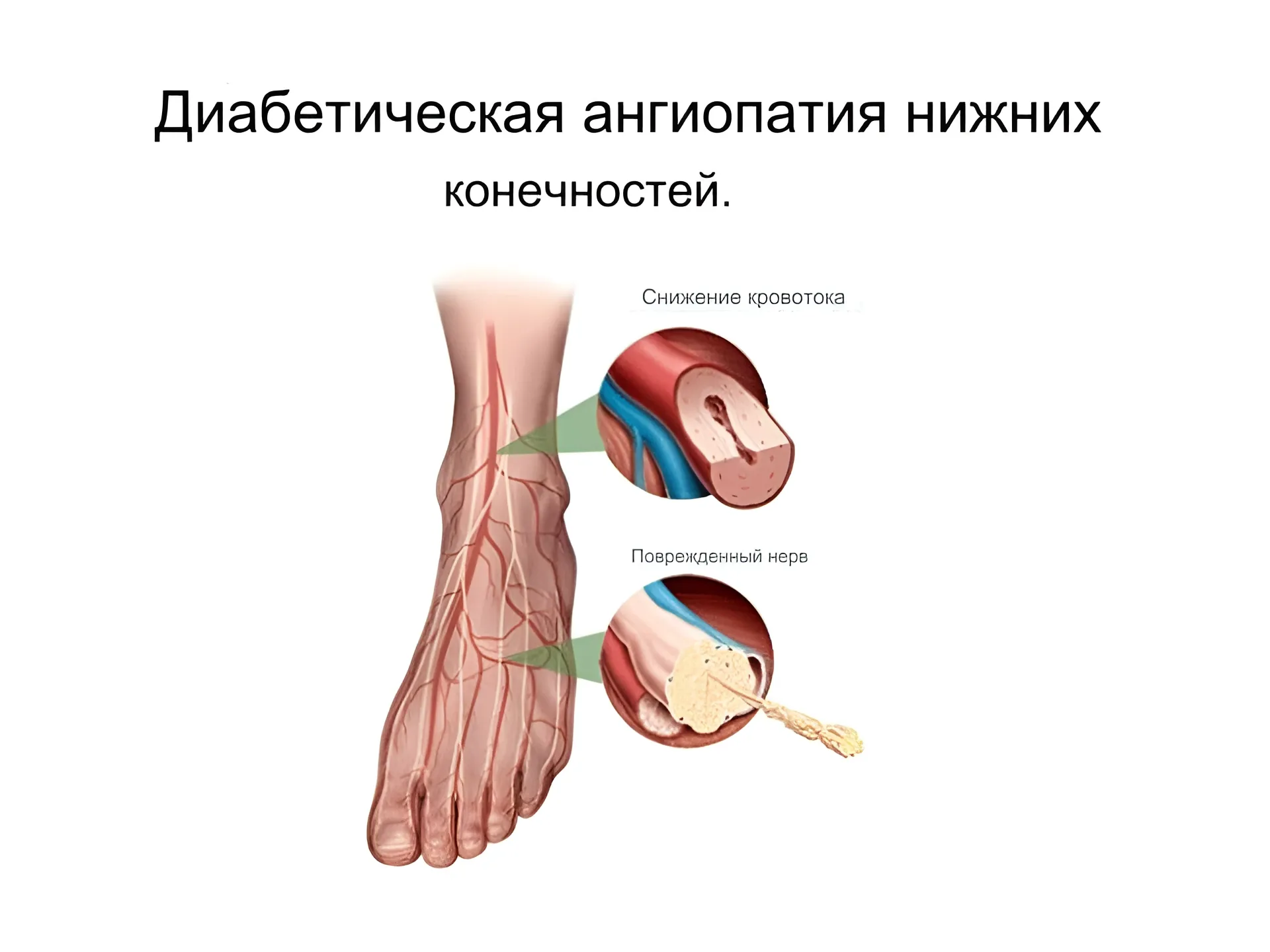 Диабетическая ангиопатия нижних конечностей