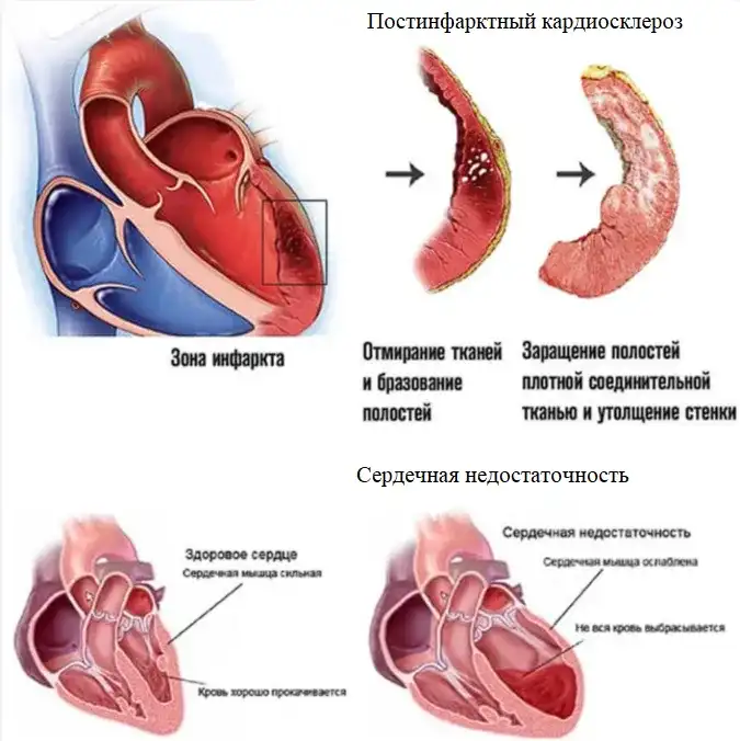 Ишемическая болезнь сердца ᐈ Лечение и симптомы | Университетская клиника г. Фрайбурга