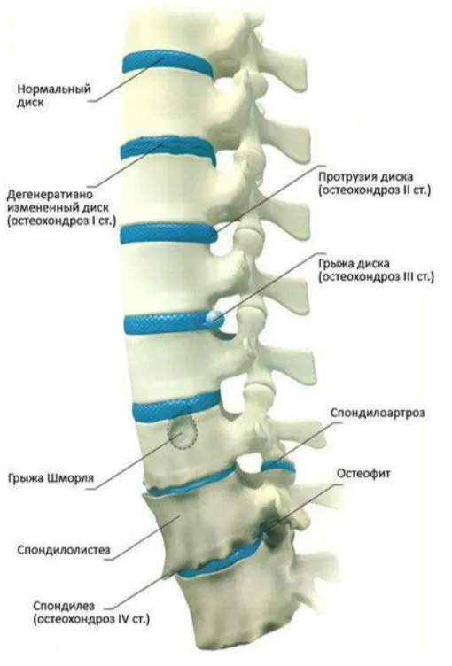 Остеохондроз