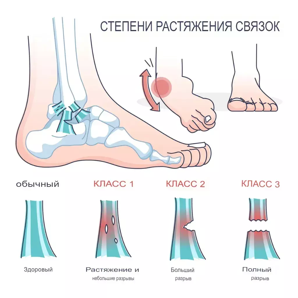 Повреждение связок голеностопного сустава