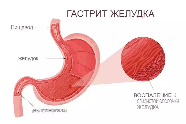 Лечение гастрита в Германии: цена | Университетская клиника г. Фрайбурга