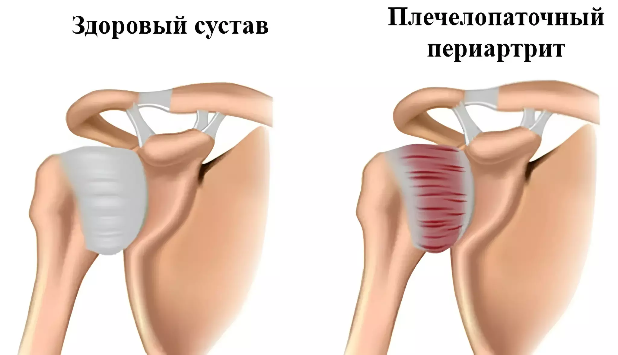 Плечелопаточный периартроз лечение в домашних условиях. Плечелопаточный периартрит. Лечение плечелопаточного периартрита в. Плечелопаточный периартрит: симптомы, диагностика, лечение в Москве Плечелопаточный периартроз (синдром "замороженного плеча") - лечение в.