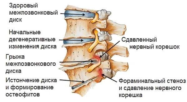 Что такое корешковый синдром (радикулопатия)?