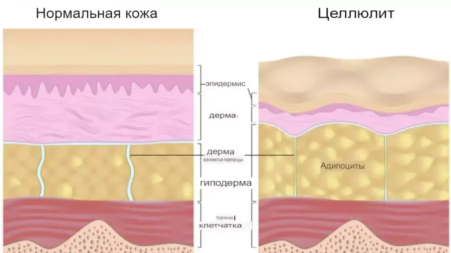 Что такое целлюлит? Что такое целлюлит?