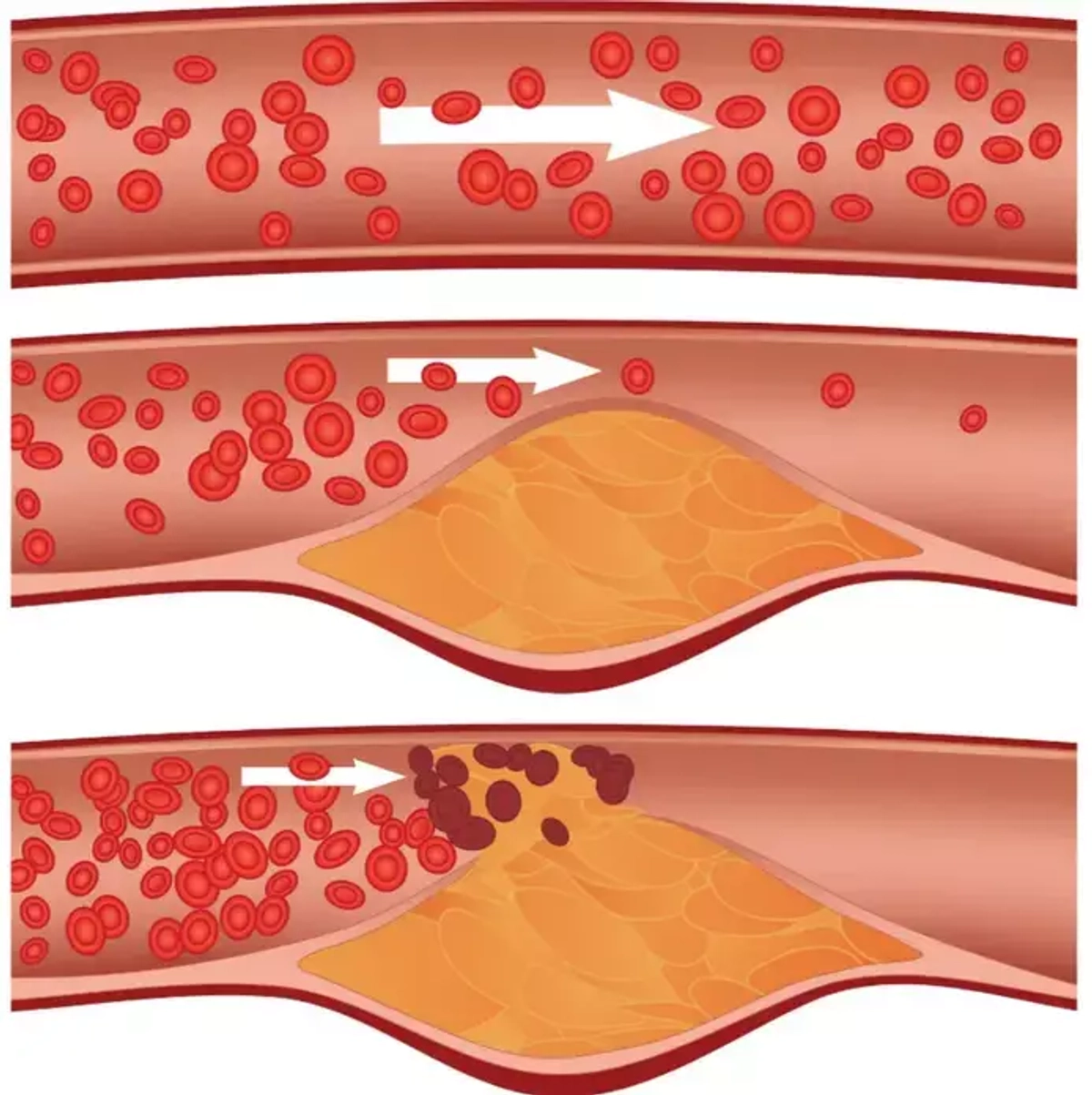 Диабетическая ангиопатия