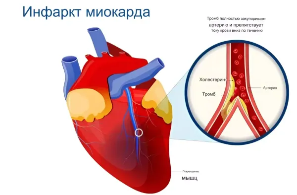 Инфаркт миокарда