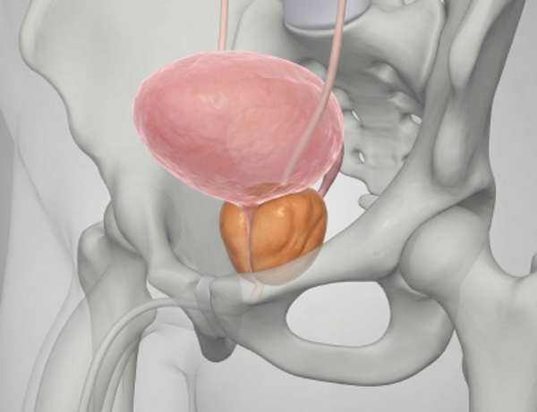 Доброкачественная гиперплазия предстательной железы (ДГПЖ) Доброкачественная гиперплазия предстательной железы (ДГПЖ)