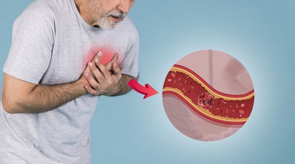 Ишемическая болезнь сердца