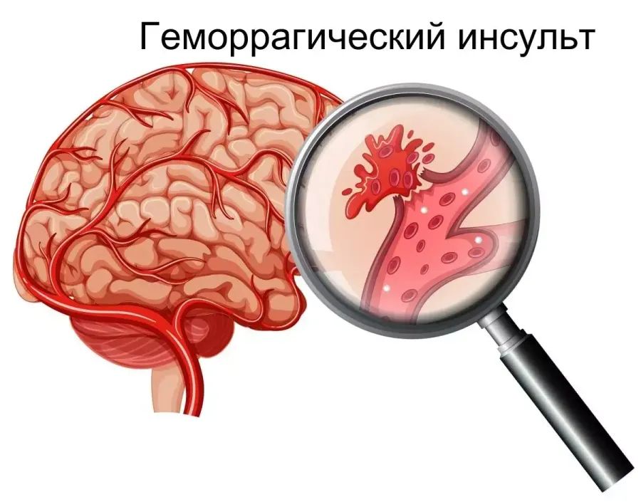 Инсульт Инсульт