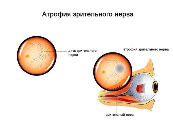Атрофия зрительного нерва: причины, лечение и роль физиотерапии