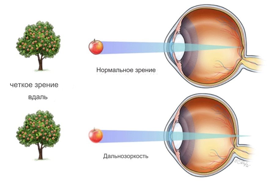 Дальнозоркость Дальнозоркость