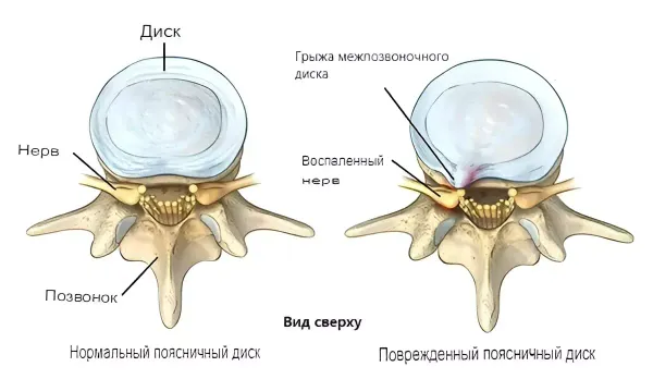 Позвоночная грыжа