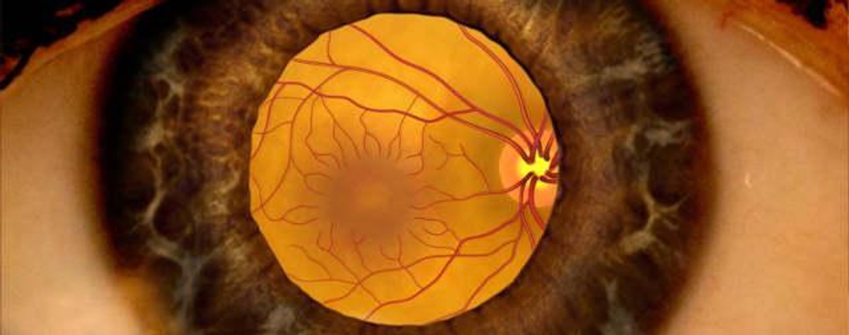 Отек макулы: симптомы, причины, лечение