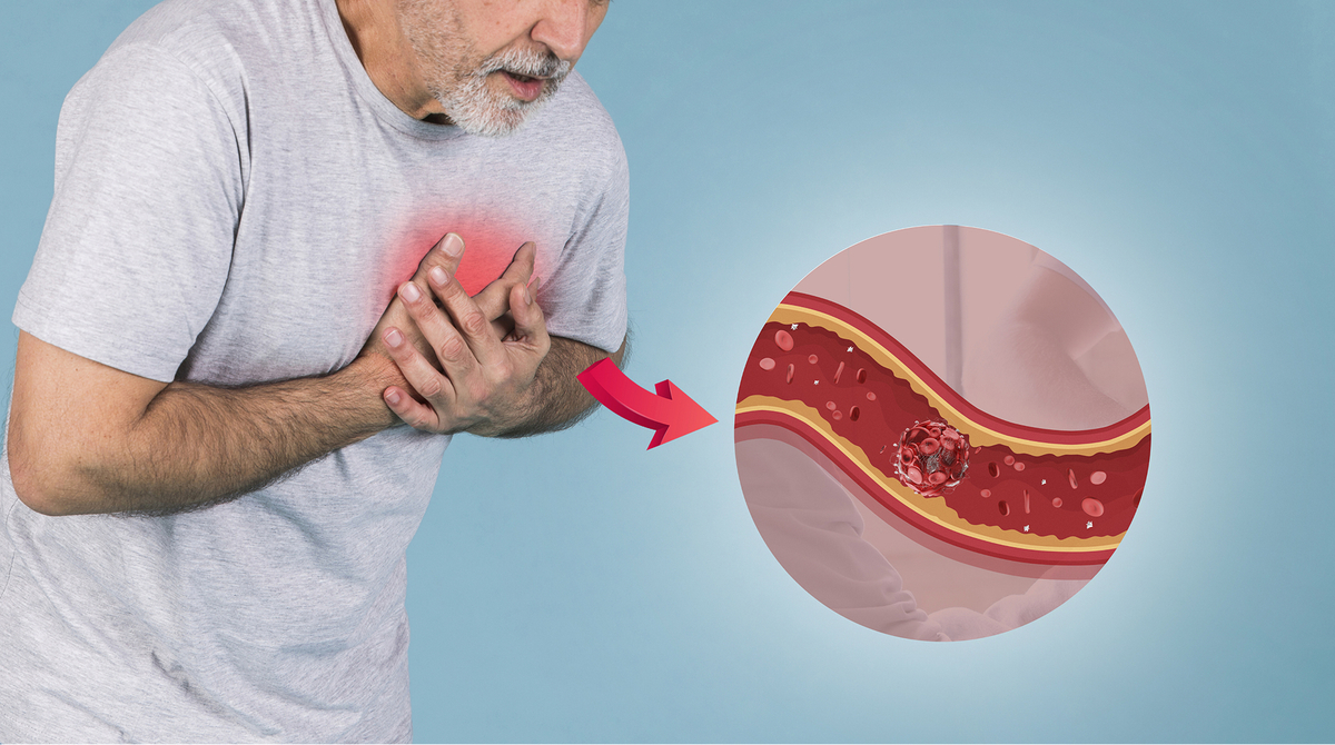 Ишемическая болезнь сердца