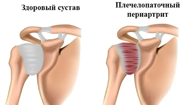 Что такое плечелопаточный периартрит?