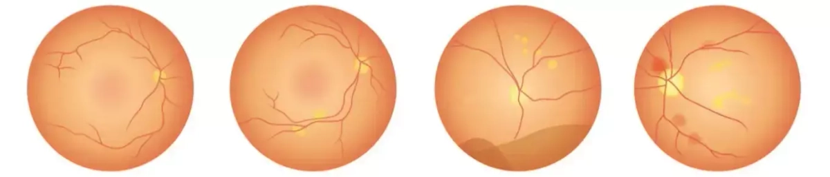 Диабетическая ретинопатия
