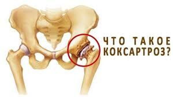 Коксартроз тазобедренного сустава - диагностика и лечение.